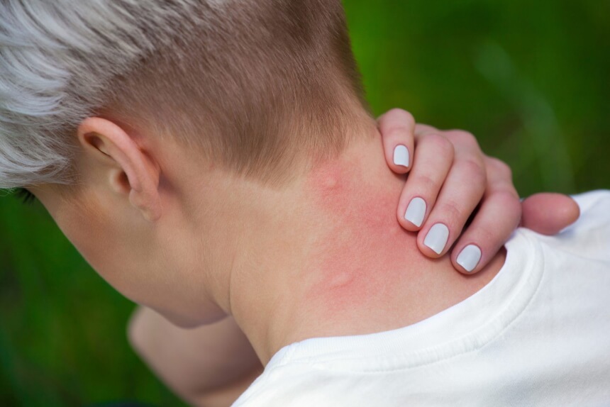 Do Gnats Bite: Reasons and Treatment Tips