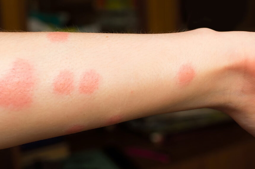 How to Get Rid of Fleas Without Losing Your Mind